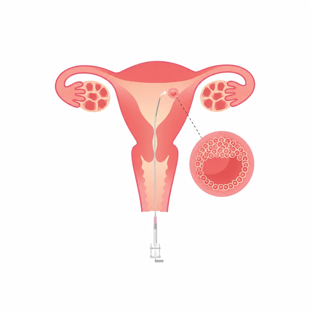 Illustration of an embryo transfer into the uterus