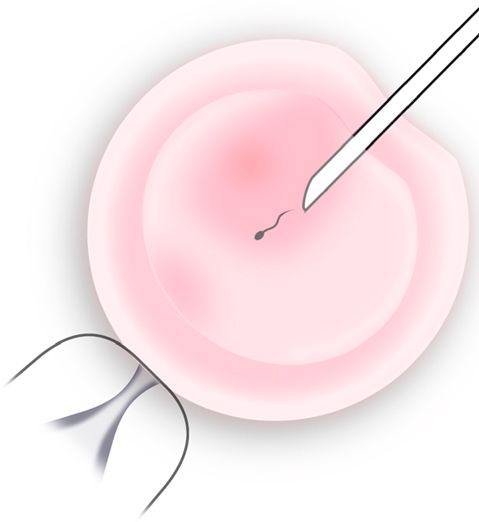 Single sperm being injected into an egg with a microneedle