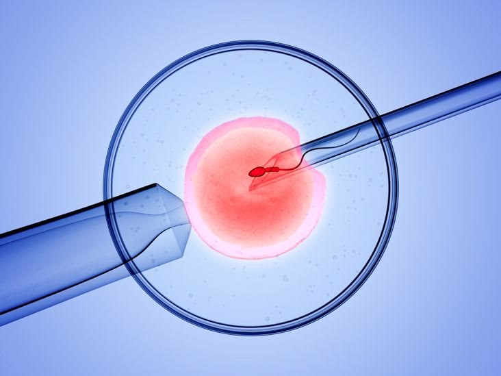 Illustration of the insemination catheter procedure