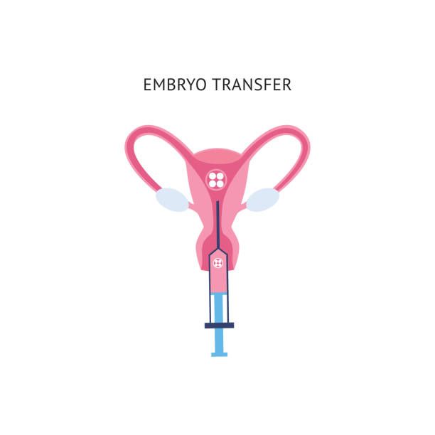 Illustration of embryo transfer into the uterus